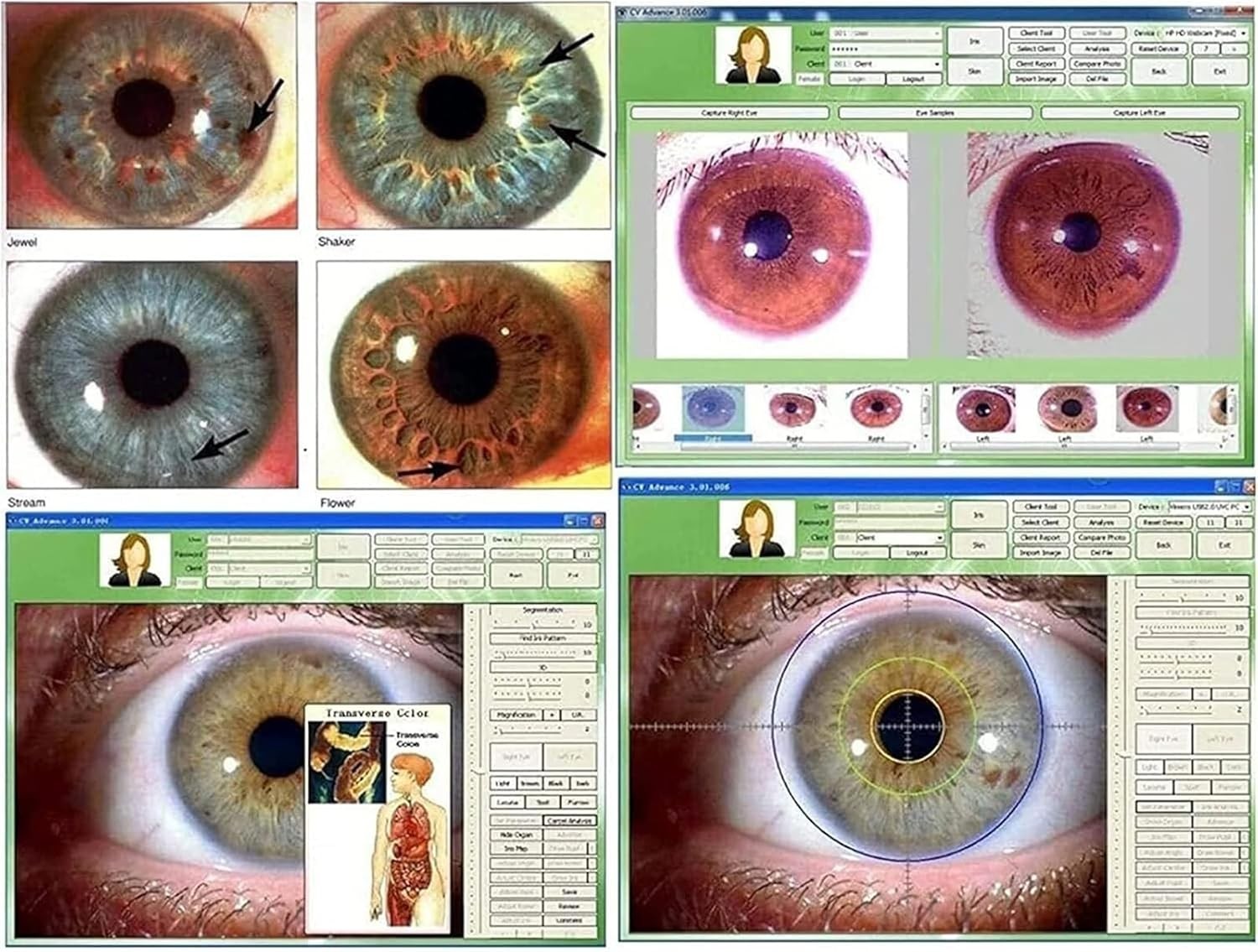 New 5.0MP USB Iriscope Iris Analyzer Iridology Camera with Iris English Software
