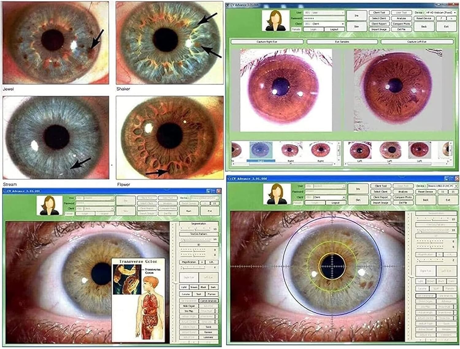 5.0 MP-USB Iriscope Iris Analyzer Iridology Camera with Iris English SoftwareNEW